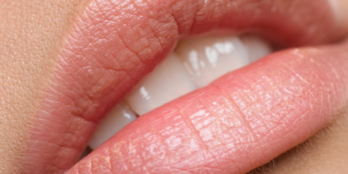 Lippen aufspritzen